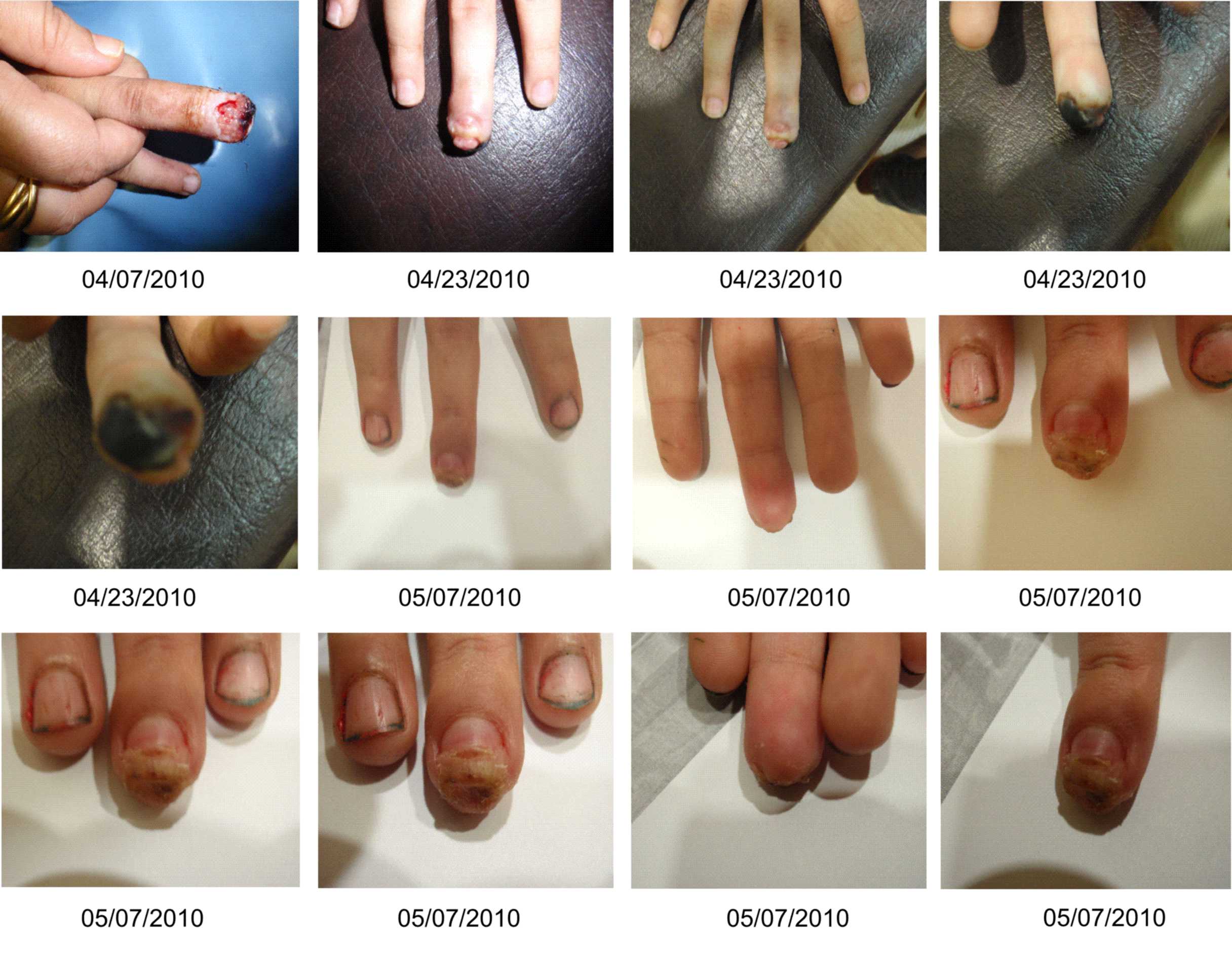 How Amputated Finger Tips Regenerate | Stem Cells