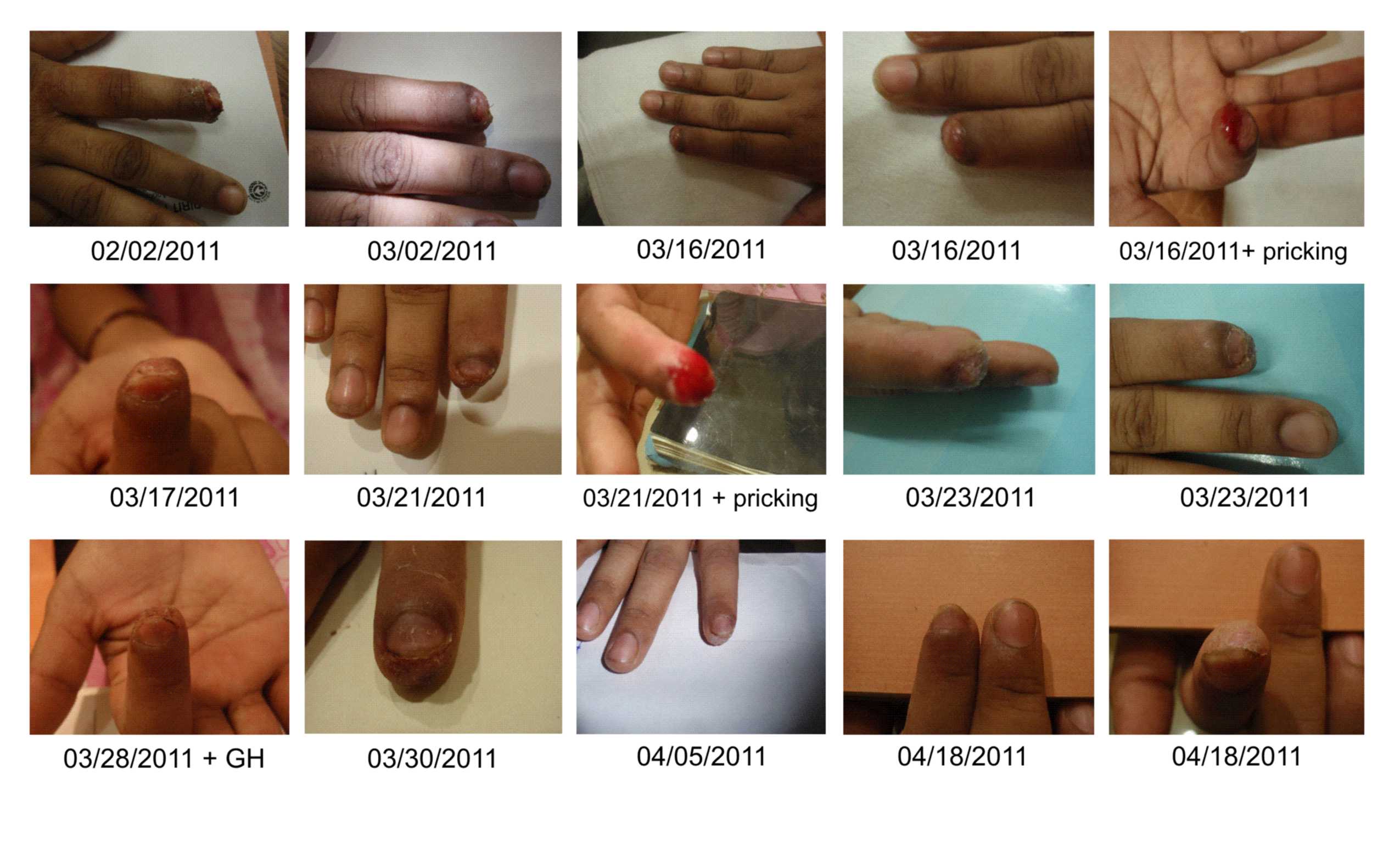 growth on fingertip