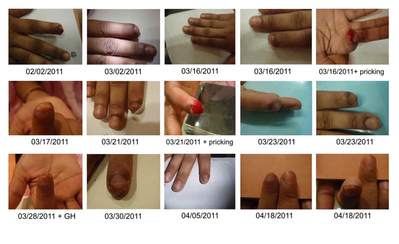 Adult Fingertip Regeneration